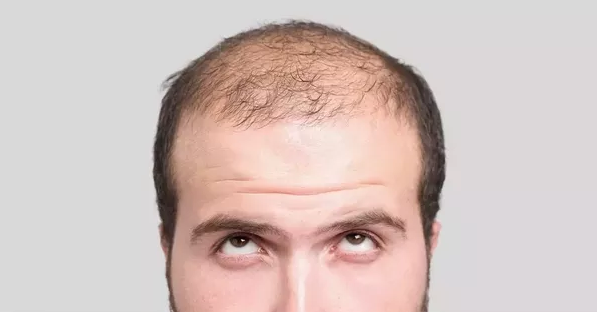 Can Hair Transplant change my life?